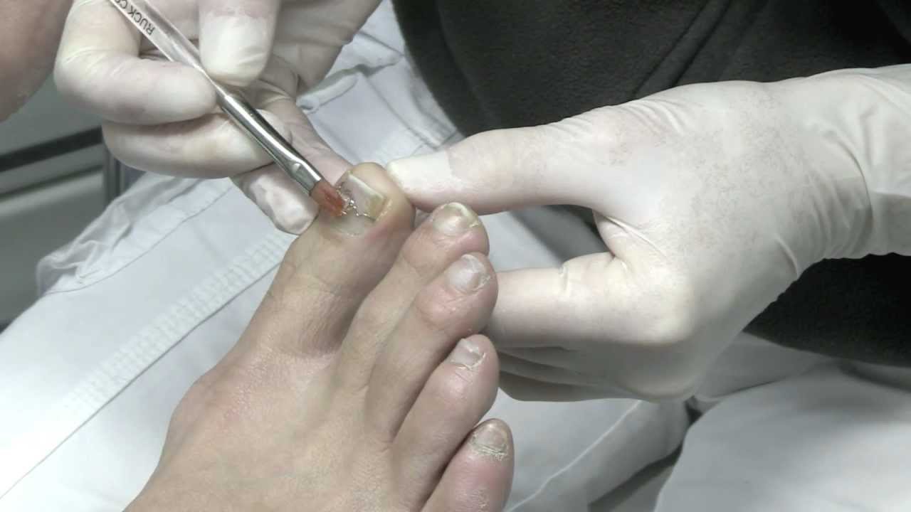 Nagelkorrekturspange