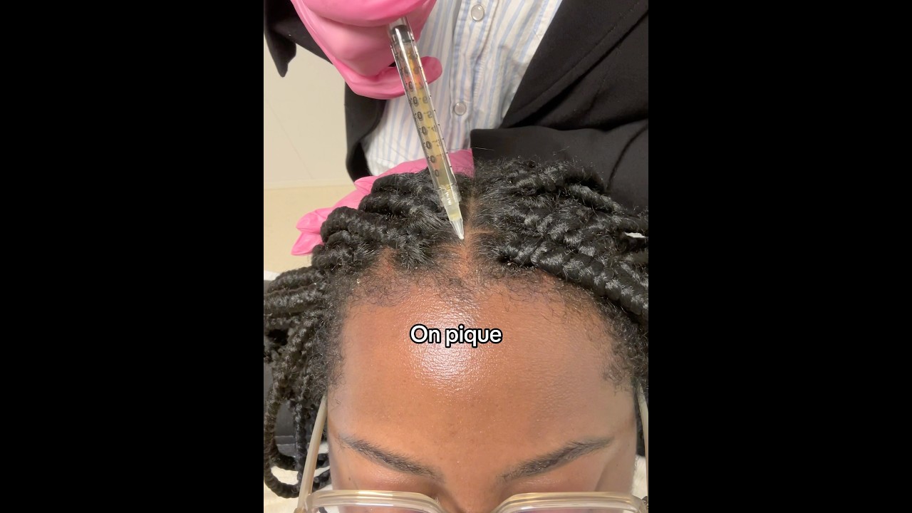 PRP pour retrouver une belle densit&eacute; capillaire #plasmaricoenplaquetas #alopecia #morningroutine