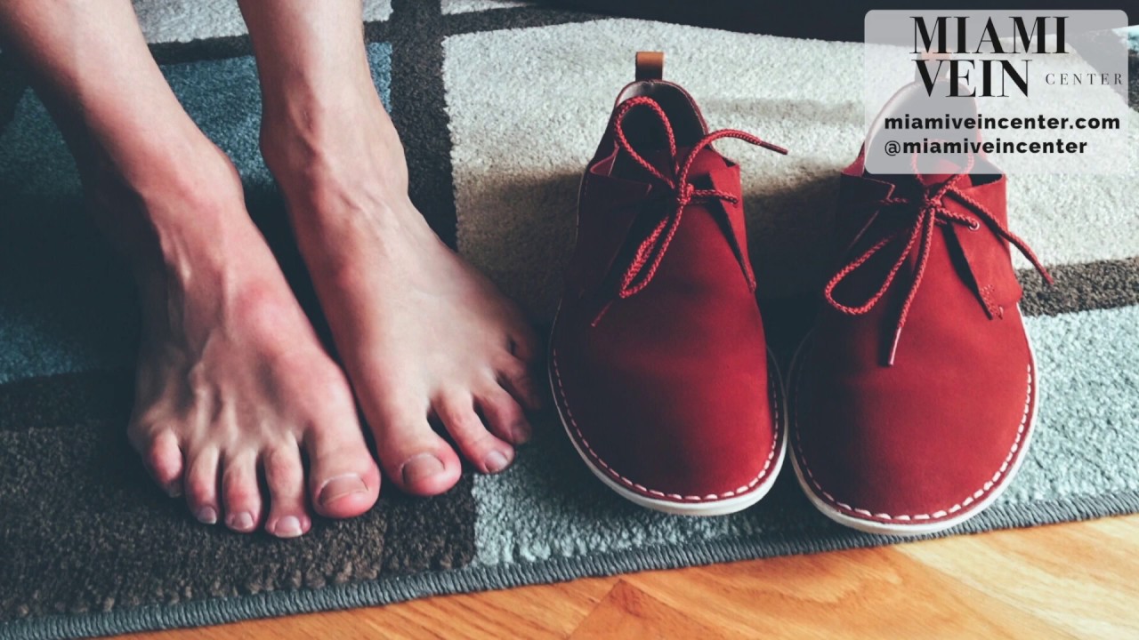 Varicose Veins in the Feet Miami Vein Center
