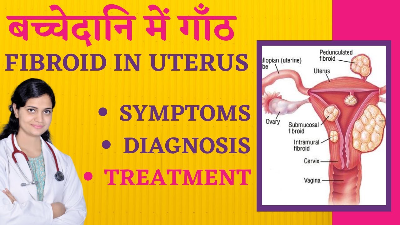 बच्चेदानि में गाँठ या रसौली के कारण, लक्षण, इलाज | Fibroid Uterus Treatment, Symptoms in Hindi
