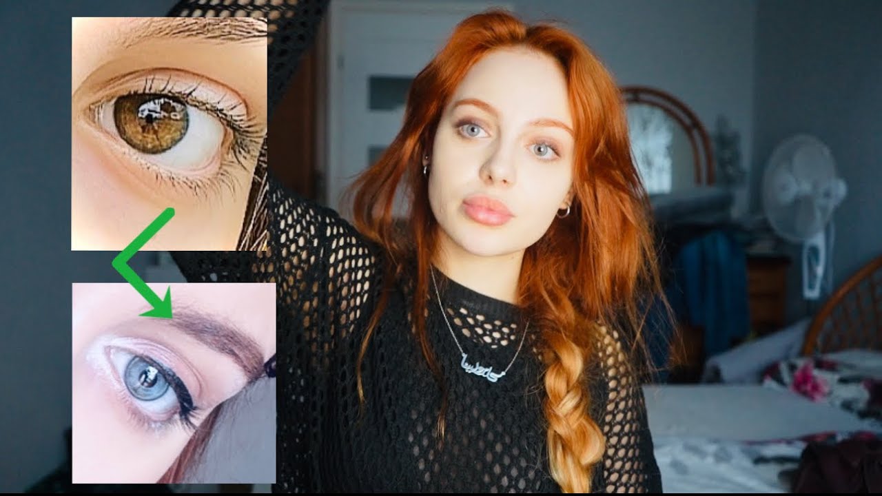 CHANGED MY EYE COLOUR FROM BROWN TO BLUE WITH KERATOPIGMENTATION- EYE COLOUR CHANGE SURGERY