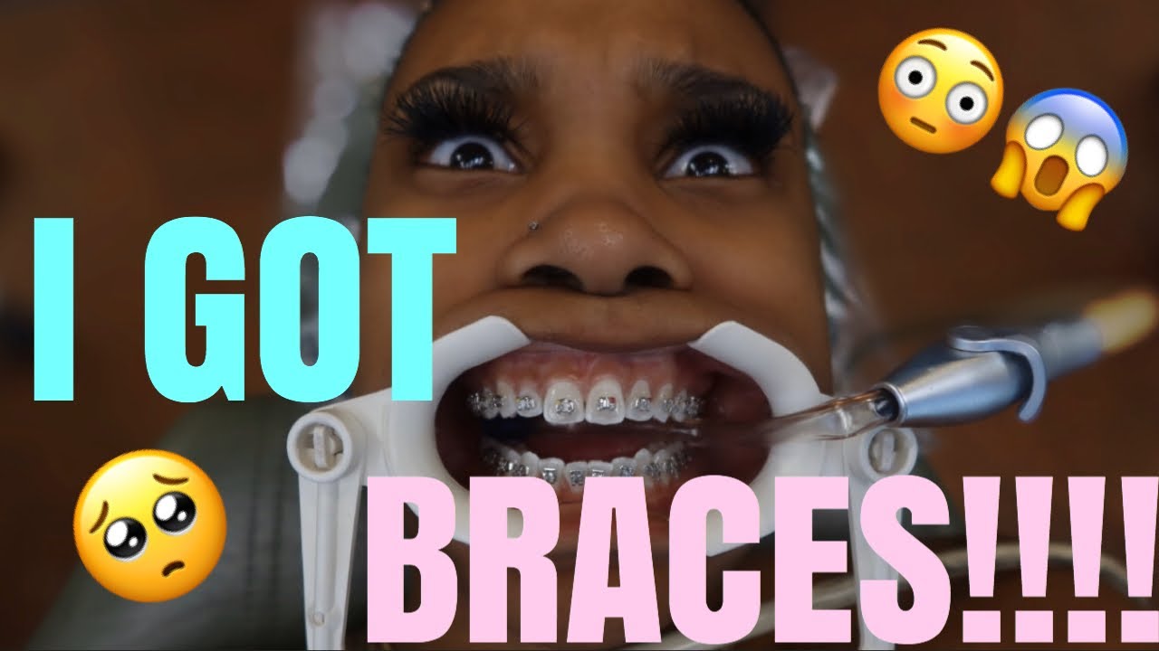 I GOT BRACES!!!