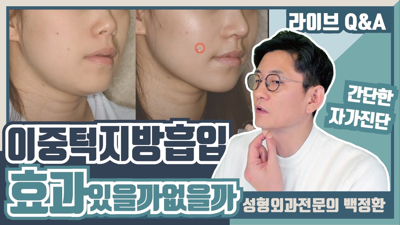 이중턱, 턱밑 지방흡입 효과가 있는지 없는지 자가진단법