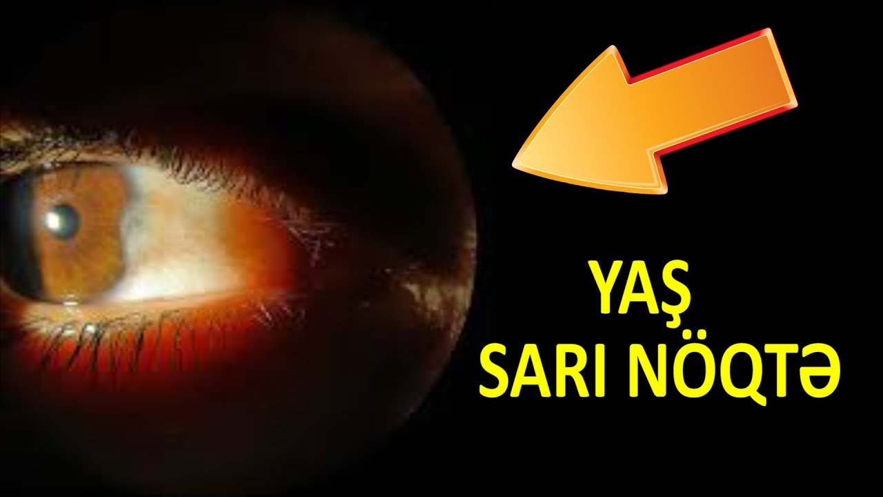 Gözdə yaş sarı nöqtə xəstəliyi - İynə ilə müalicə