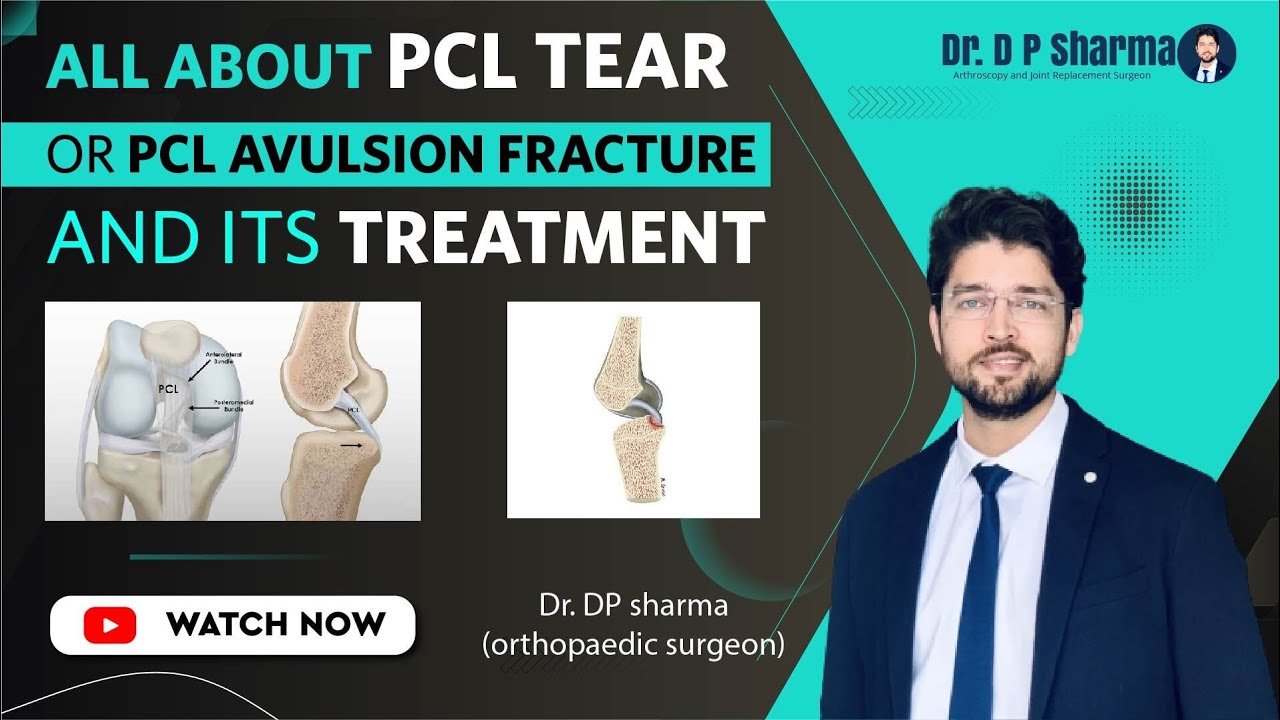 All About PCL Tear Or PCL Avulsion Fracture And Its Treatment In Noida, Greater Noida | Dr DP Sharma