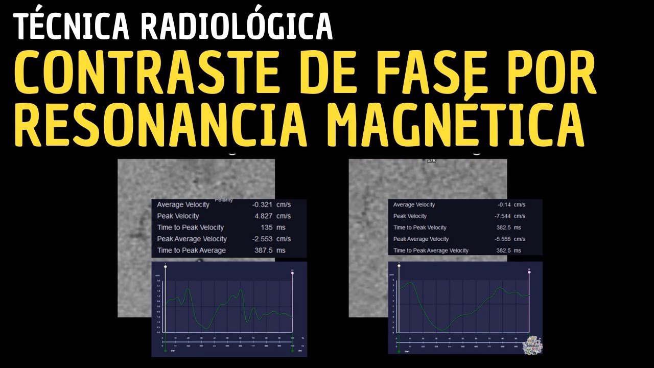 Técnica Radiológica: Contraste de fase por Resonancia Magnética.