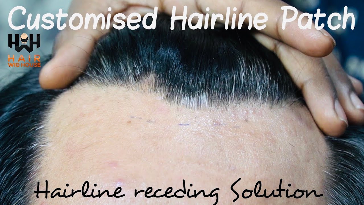 Hairline Receding Solution | Customised Hairline Patch | Hair wig house | 9953384242