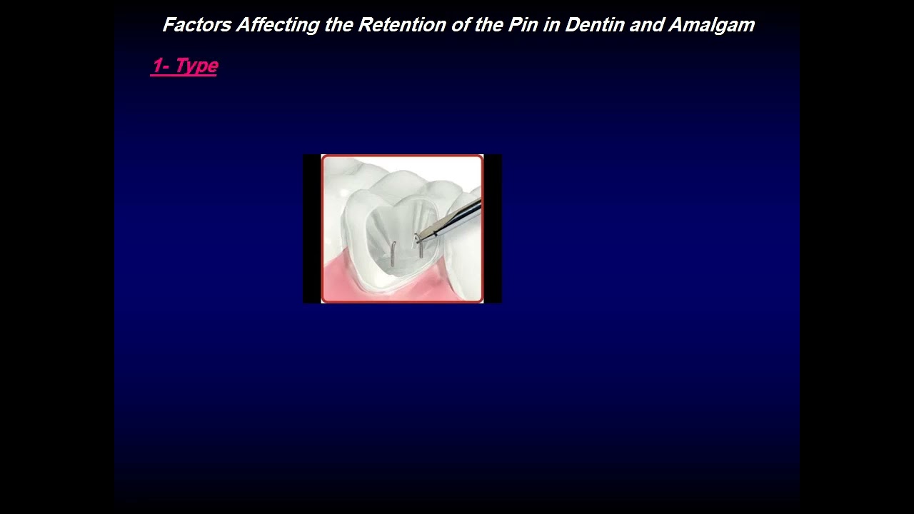 Pin retained amalgam restoration