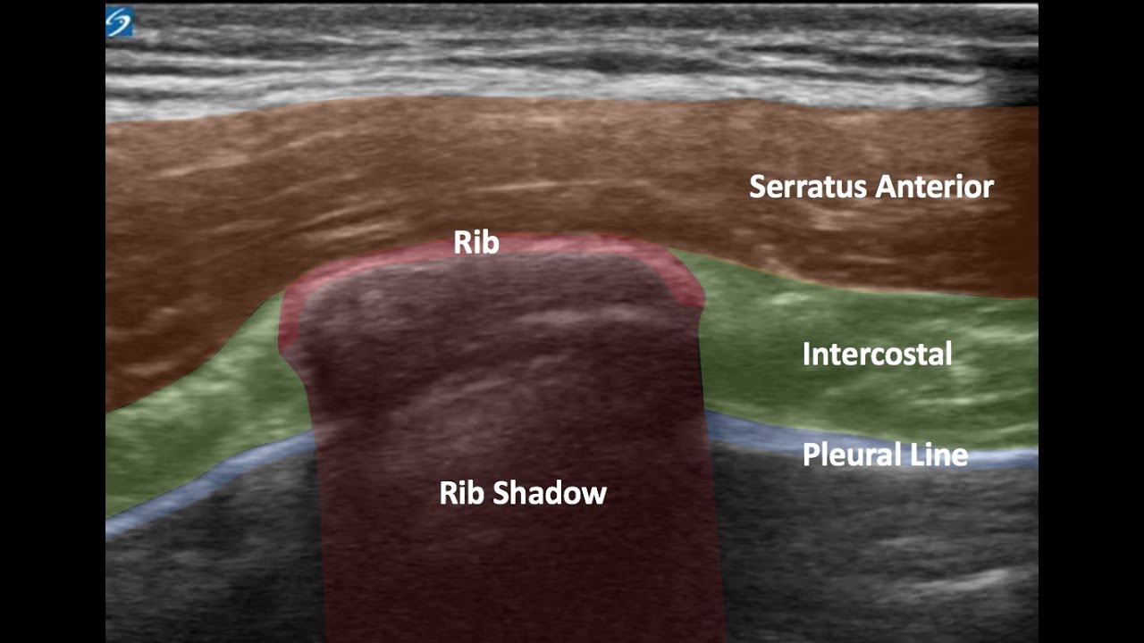 Serratus Anterior block for rib fracture pain management. 4/2021