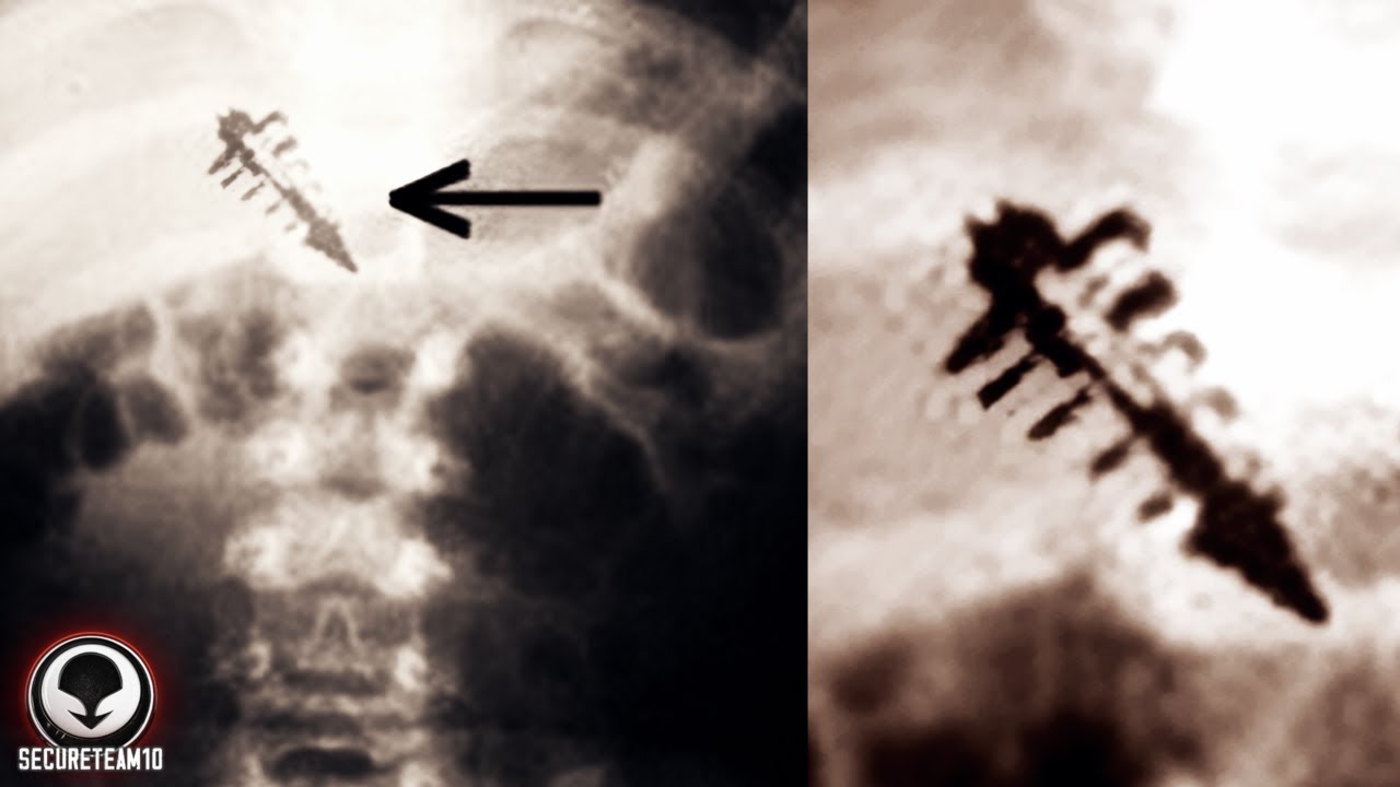 JEŚLI ZNAJDZIESZ TEN DZIWNY ŚLAD NA SWOJEJ SK&Oacute;RZE... UCIEKAJ.