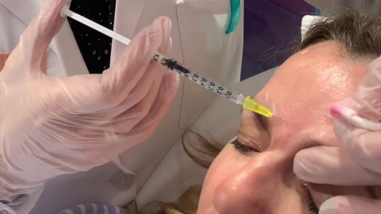 Cómo aplicar Neuromoduladores para eliminar arrugas faciales y patas de gallo | Dermaforyou