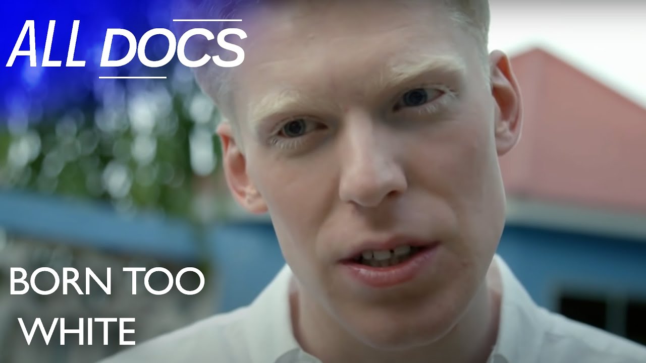 What It's Like To Have Albinism in Tanzania | Full Documentary | All Documentary