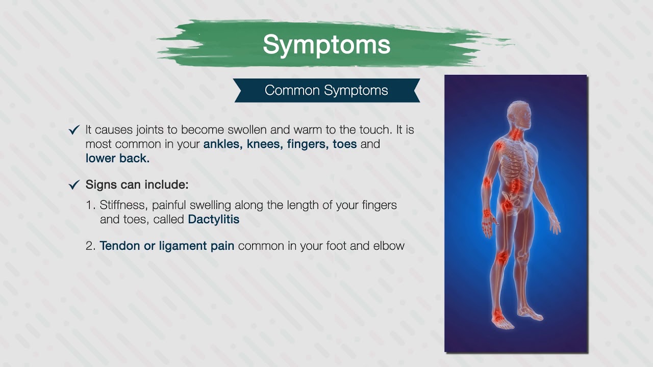 Psoriatic Arthritis Part 1