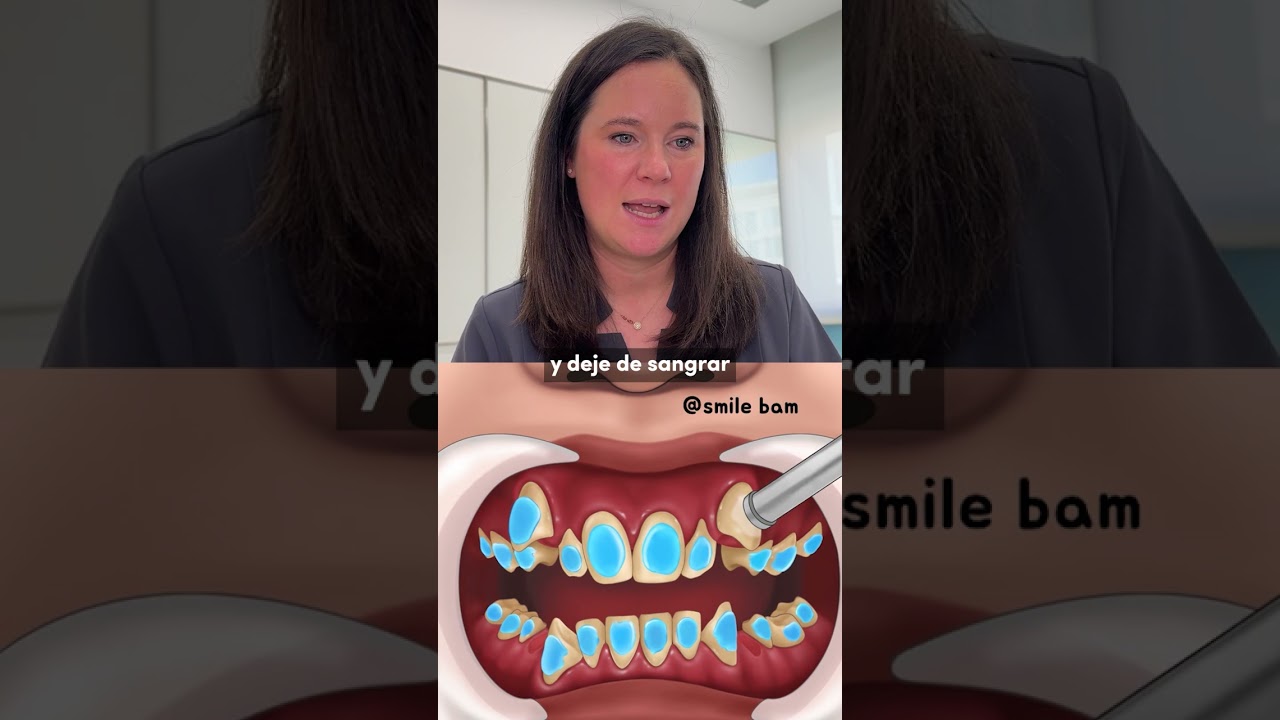 Os traigo otra reacci&oacute;n, esta vez de unos dientes con mucho sarro🦷🪛