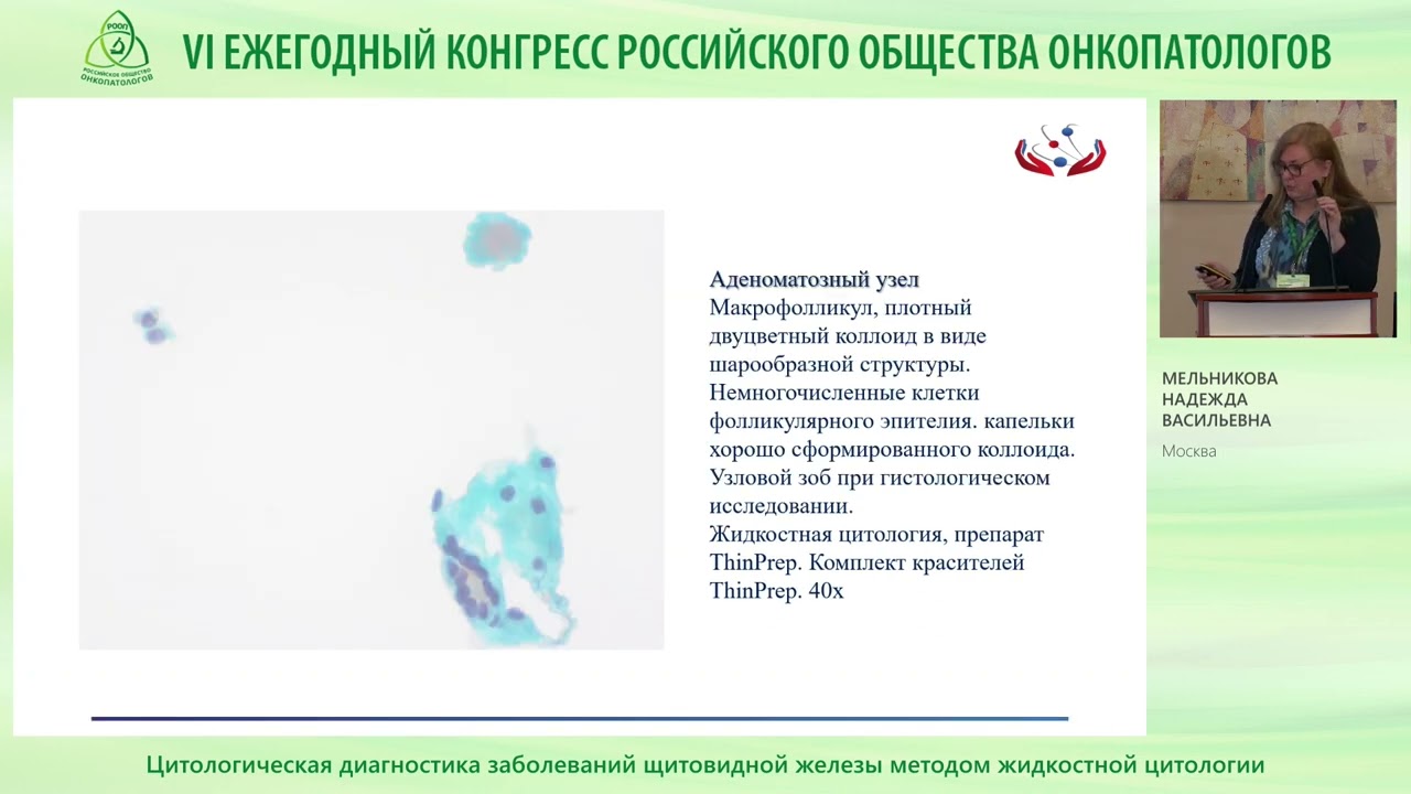 Цитологическая диагностика заболеваний щитовидной железы методом жидкостной цитологии