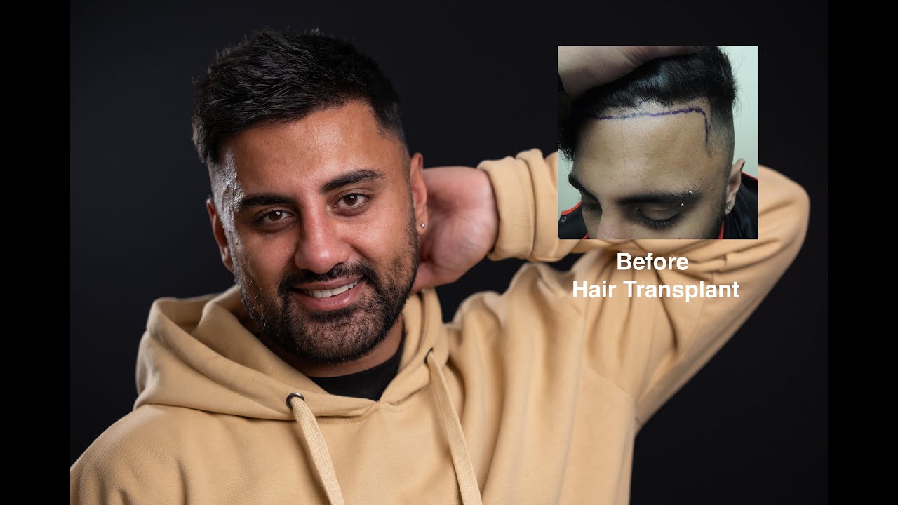 4 Years After Hair Transplant By Dr Mark Tam, Faris Shares His Hair Transplant Results And Journey