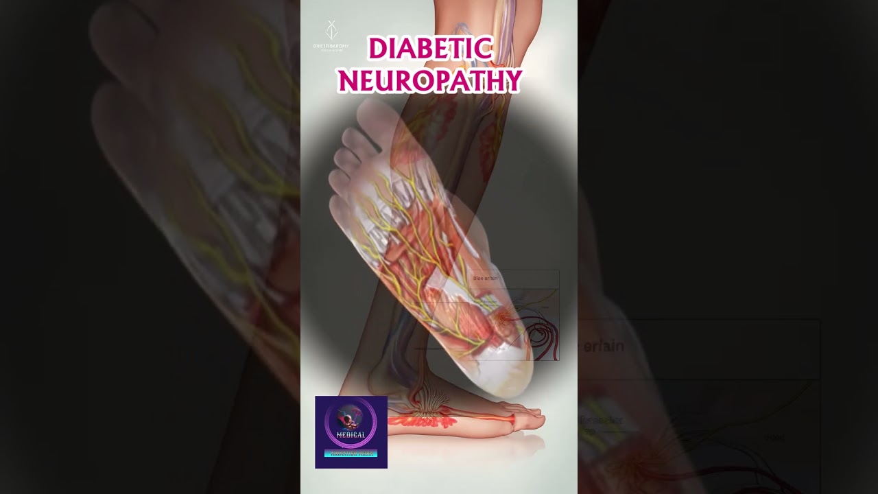 Diabetic Neuropathy