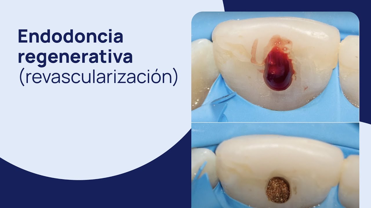 Endodoncia Regenerativa (revascularización) en un incisivo central inmaduro