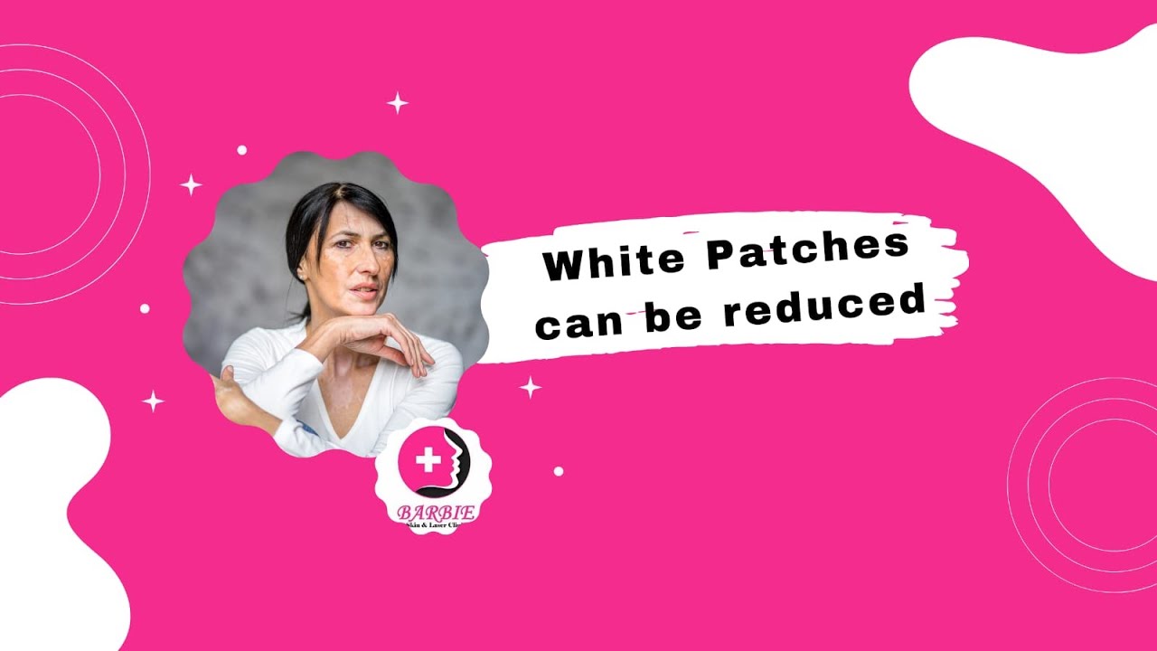 By Following Simple Steps White Patches Can Be Reduced