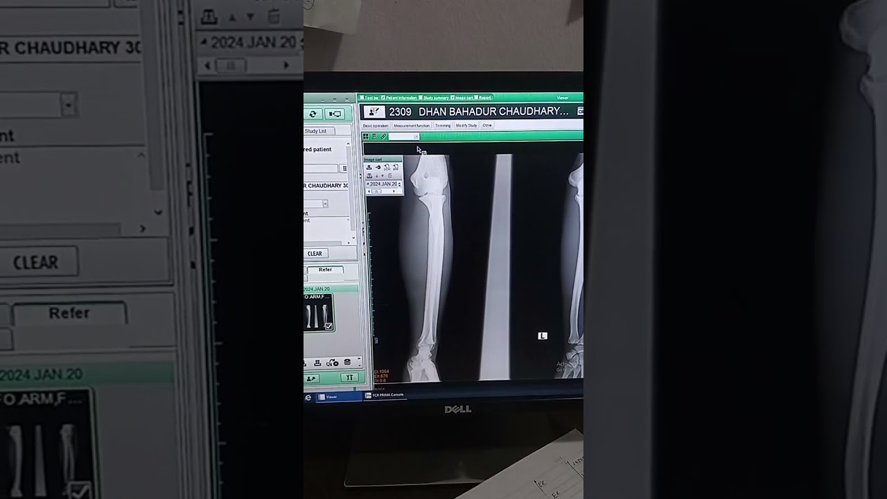 CR system Fujifilm X ray picture import in jpg