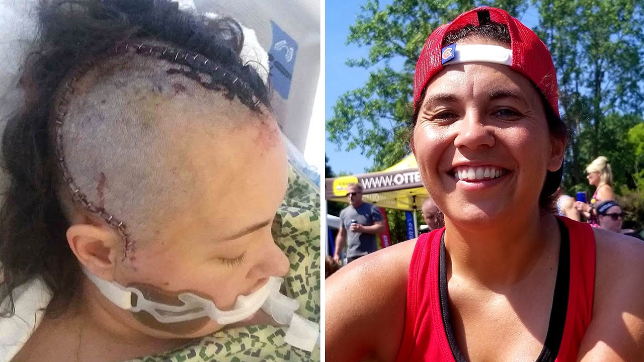 Woman Undergoes Brain Surgery to Remove Deadly AVM, Caused by Rare Genetic Condition
