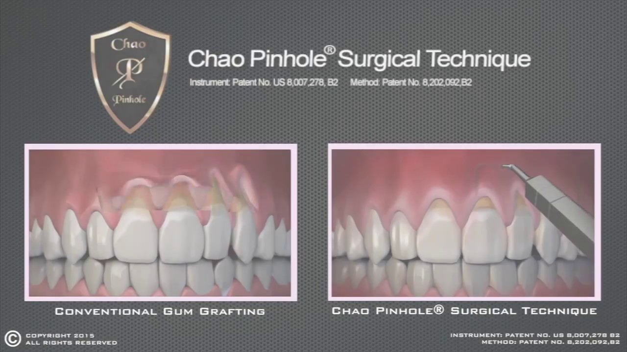 Chao Pinhole at Implant Dentistry Periodontics & Facial Rejuvenation