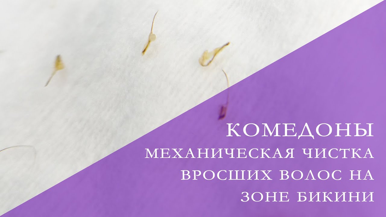 Комедоны. Чистка бикини.