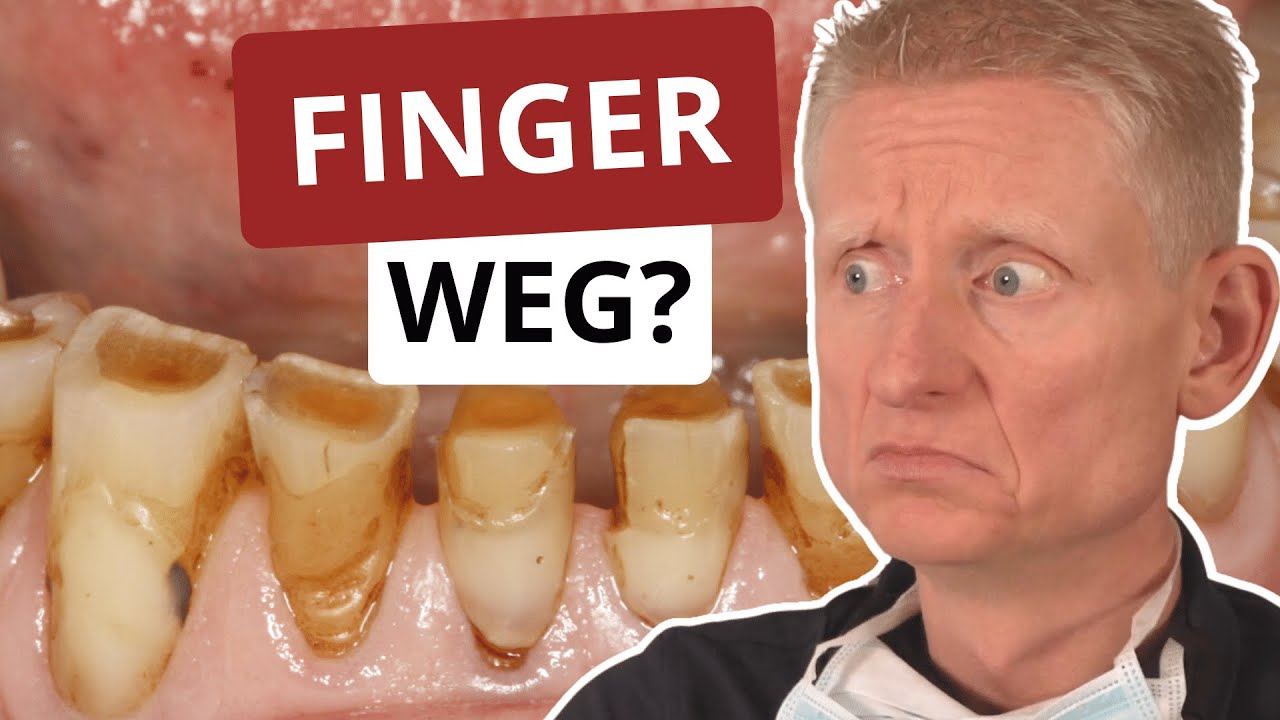 Warum Kompositveneers Sie nicht glücklich machen