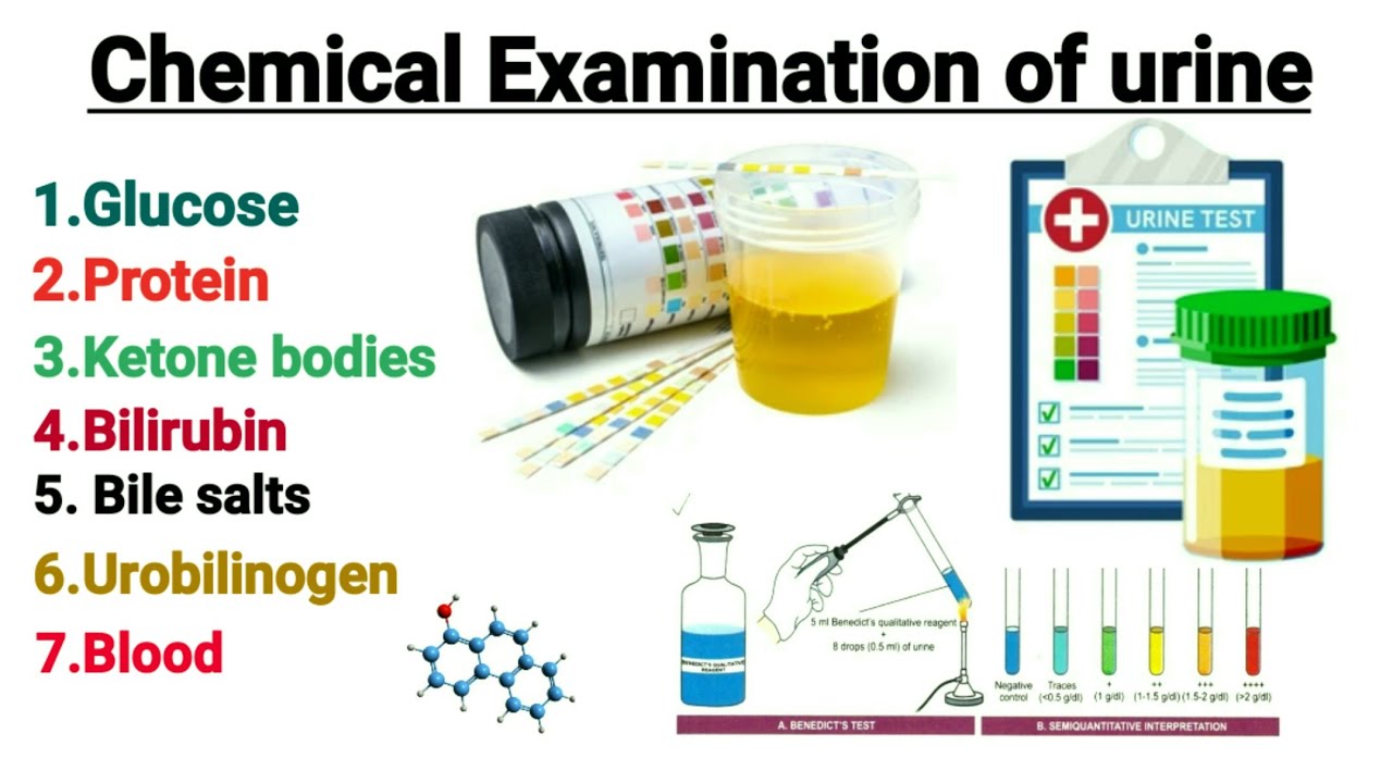 Chemical Examination of urine || Urine analysis || Glucose in urine || Glycosuria Explain in hindi