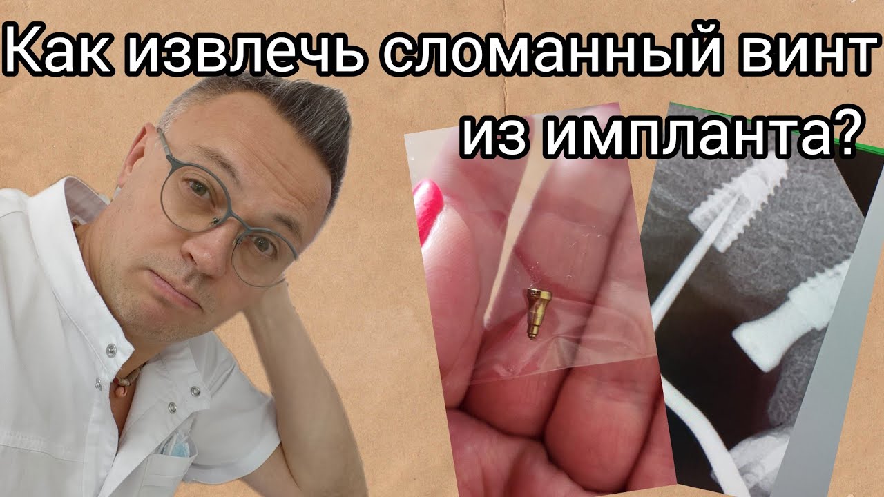 Сломал винт в импланте. Извлечение винта. 