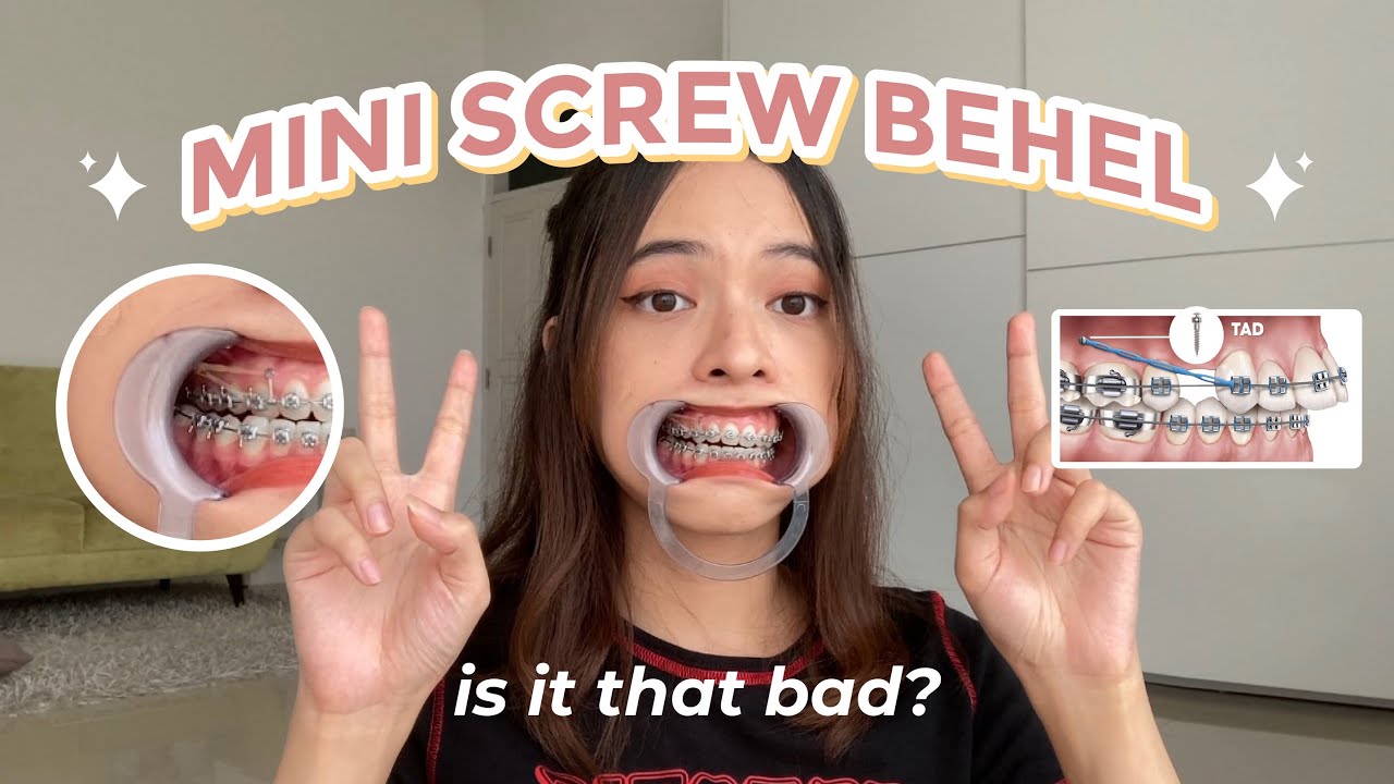 MINI SCREW BEHEL SETELAH 1 BULAN - progress ilangin gummy smile mulai keliatan! | Braces Journey