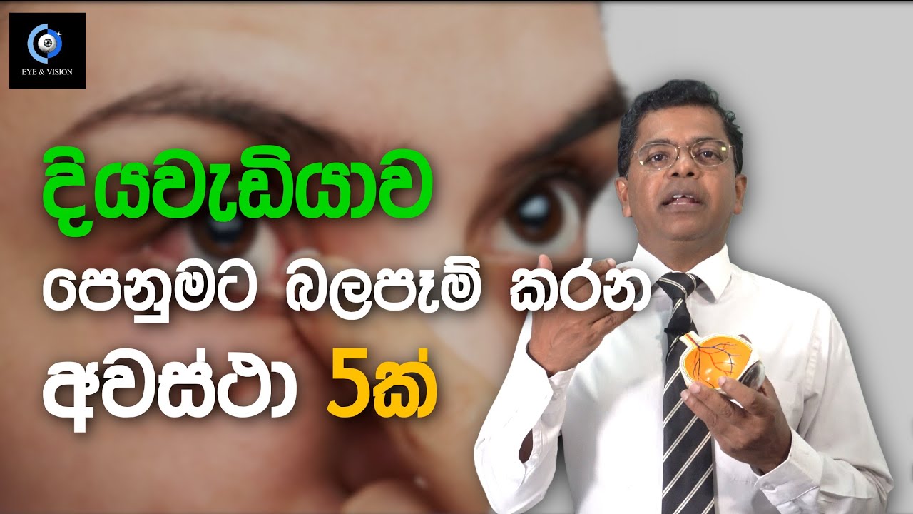 දියවැඩියාවට ඇස් පරිෂාව ආඩි කැඳ බිව්ව වගේ කරගන්න එපා | Do This Eye Examination For Diabetic