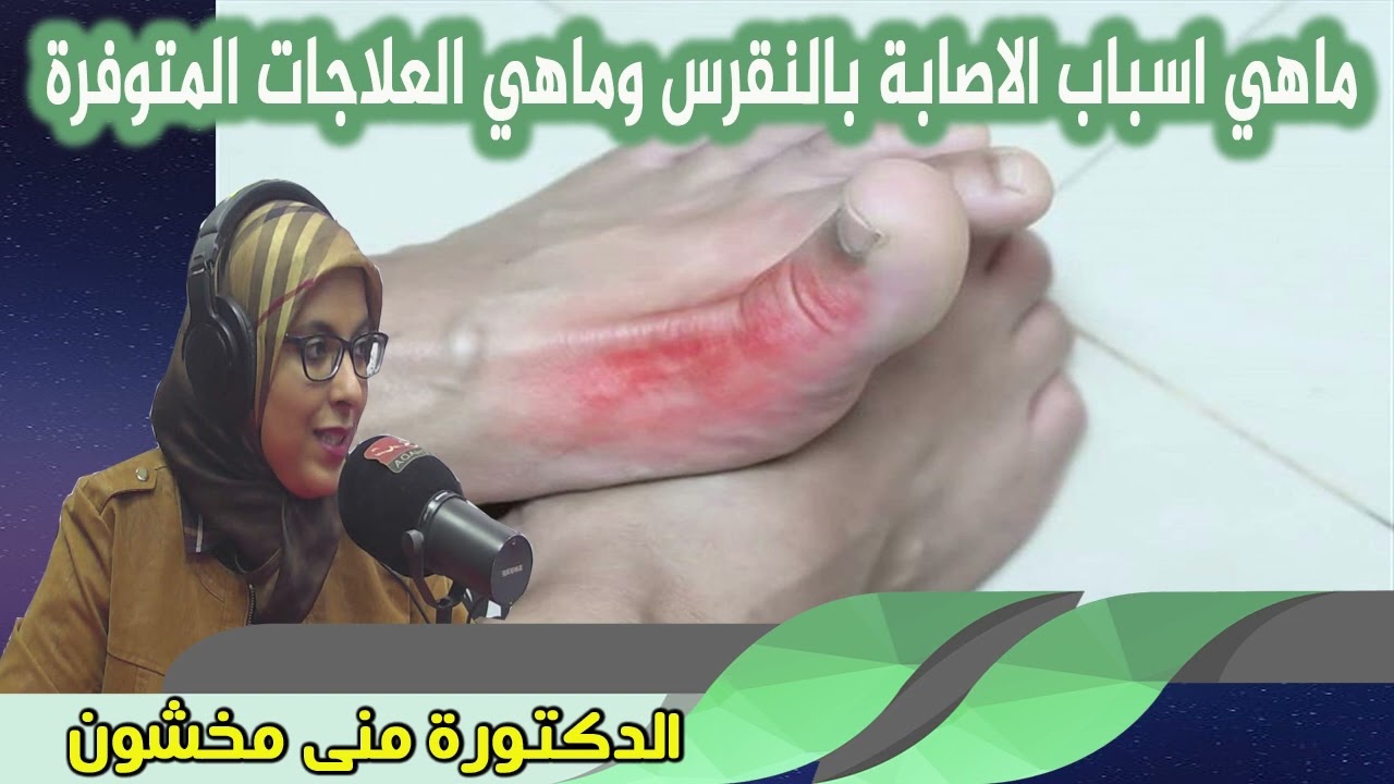 ماهي اسباب الاصابة بالنقرس وماهي العلاجات المتوفرة الدكتورة منى مخشون