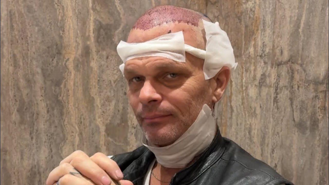 We came to Turkey for Hair Transplant Surgery... Bad Chad gets 5,200 grafts in a 8 hr procedure! 🤕💈