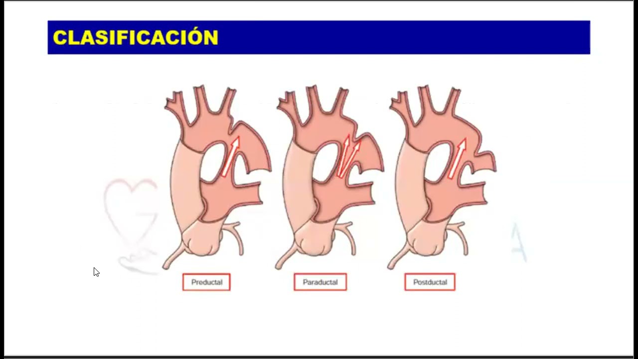 Coartación Aórtica