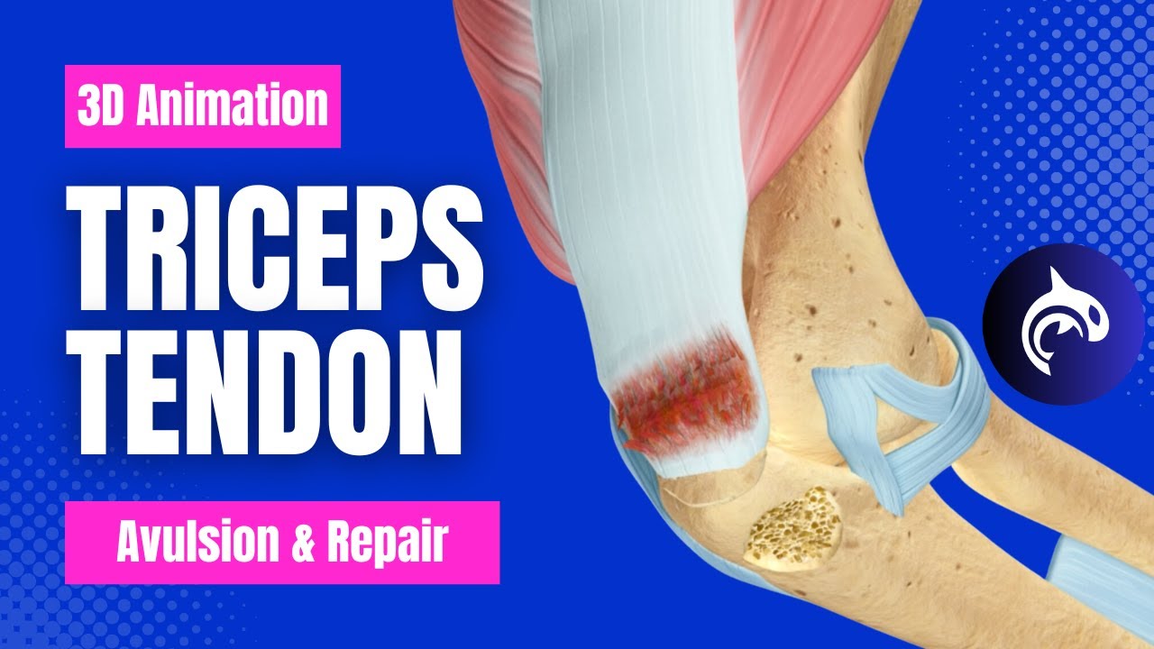 Triceps Tendon Avulsion and Repair - 3D Animation