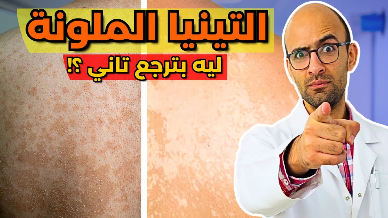اسرار الوقاية من التينيا الملونة - وليه بترجع تاني ؟!