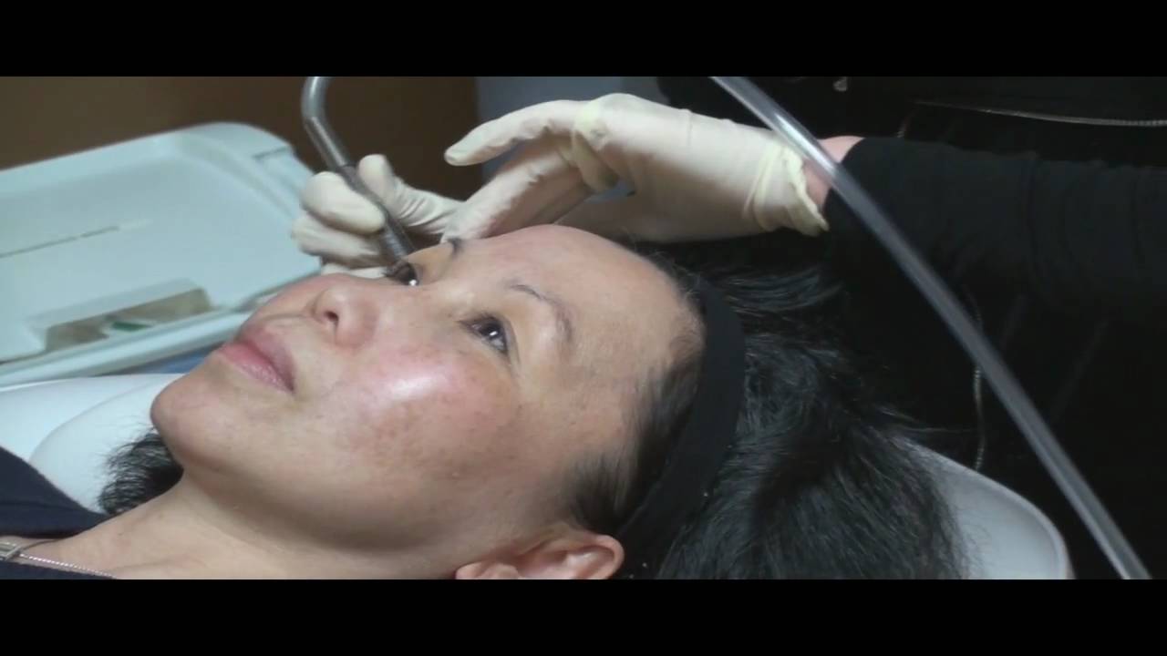 Microdermabrasion Demonstration by Dr. Young in Bellevue Washington