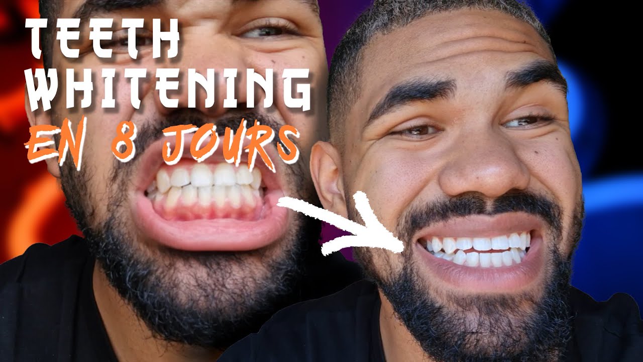 MON BLANCHIMENT DENTAIRE EN 8 JOURS | COMMENT AVOIR LES DENTS BLANCHES &Agrave; LA MAISON | GOUTTI&Egrave;RES