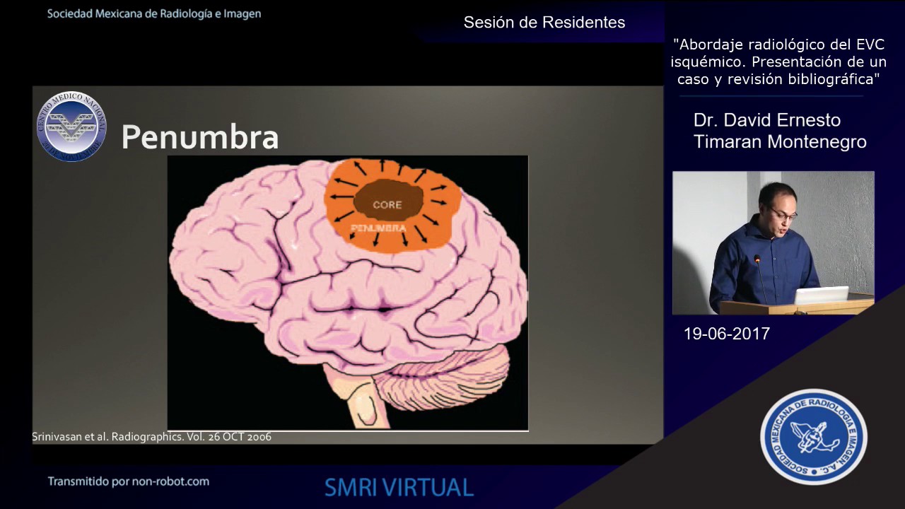 Abordaje Radiológico del EVC isquémico