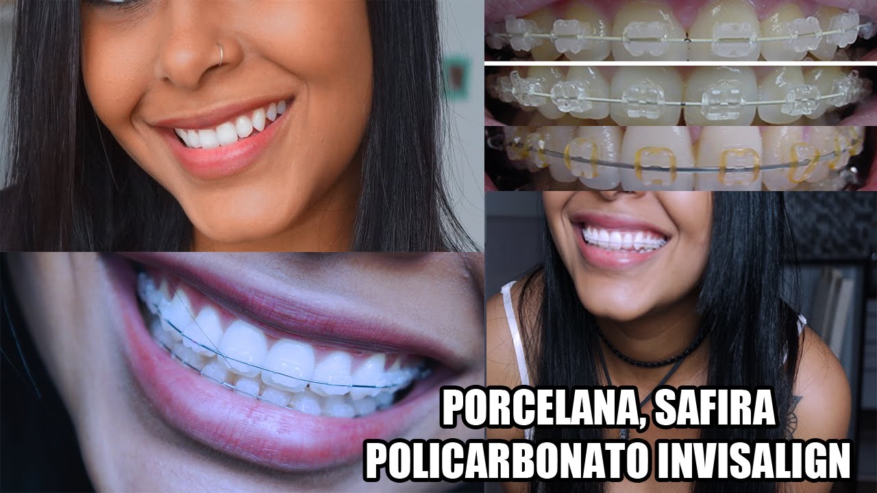 Aparelho estético porcelana (preço, dor, curiosidades...)
