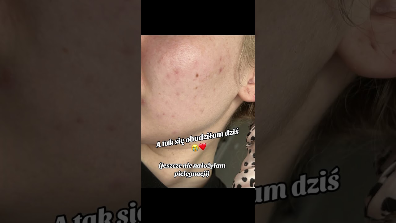 #przebarwienia #skinchange #skintra #cosibella #pielęgnacjatwarzy #kosmetyki #witaminac #skincare