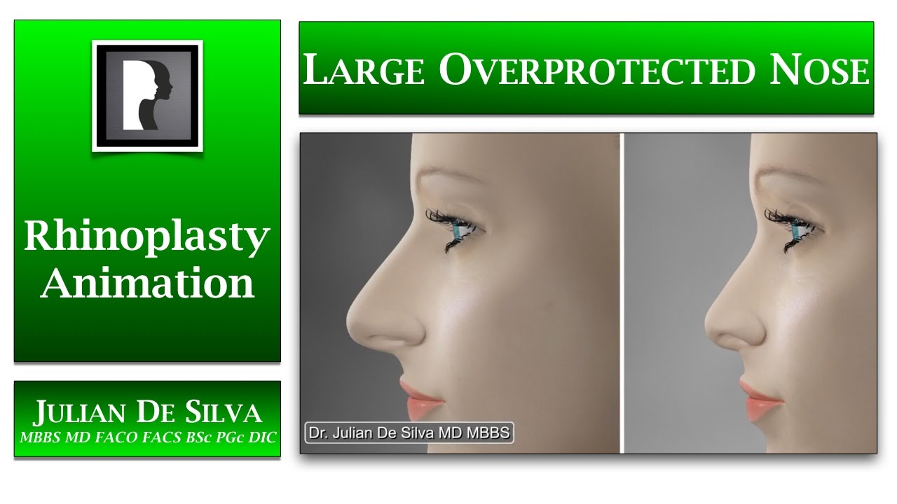 Rhinoplasty Animation - How can a Large Over-Projected nose be made SMALLER?