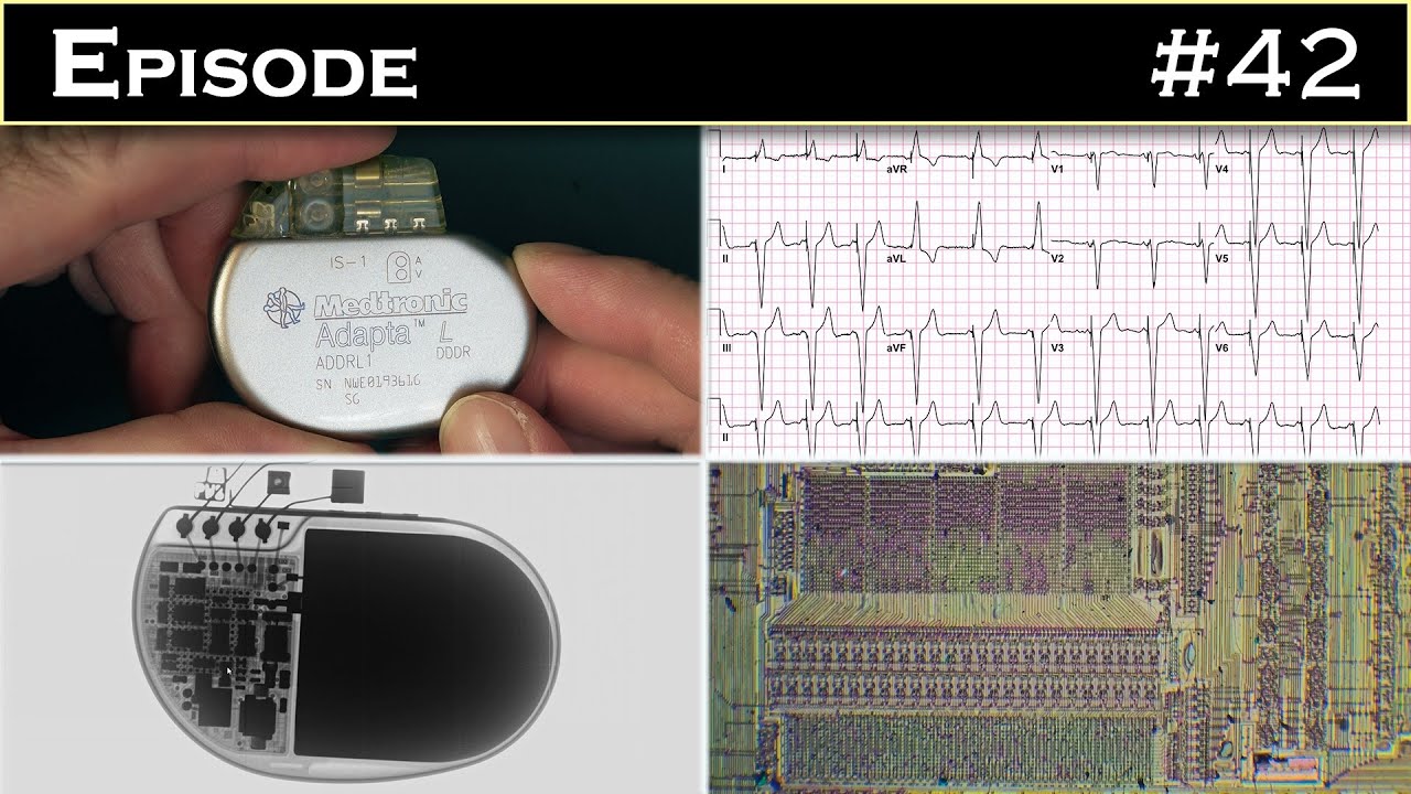 Stimulateur cardiaque : Anatomie d'un petit boitier qui sauve des vies humaines