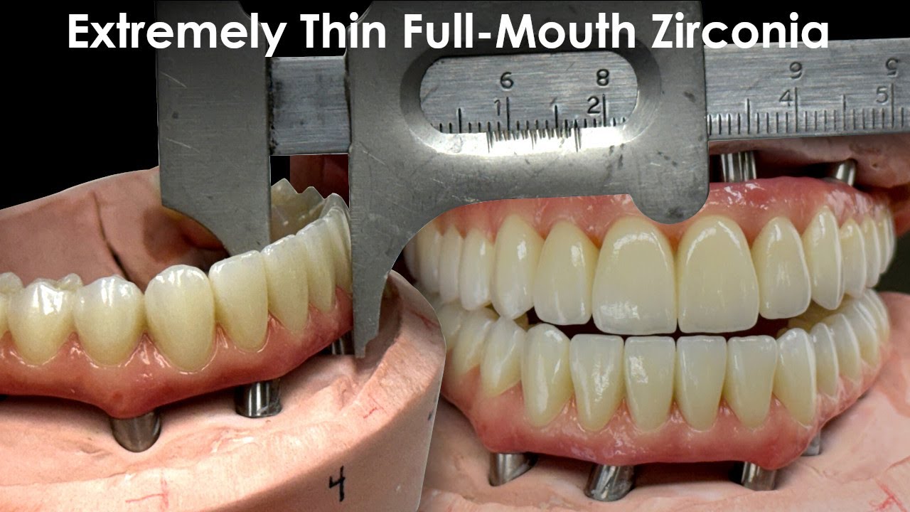 Making an Extremely Thin, Full-Mouth Zirconia Restoration