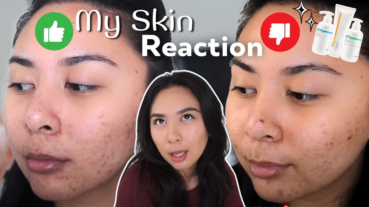 How my skin is reacting: ACNE.ORG Skin Journey | Week 3