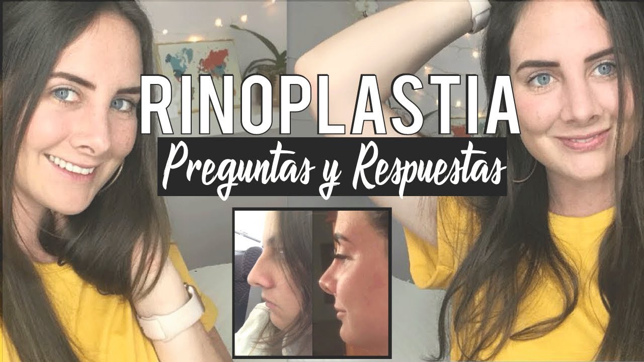 Mi Rinoplastia | Preguntas y Respuestas | Operación a la Nariz |