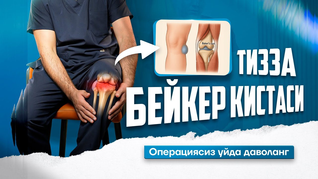 Тизза Бейкер кистаси. Операциясиз, уйда даволанг!