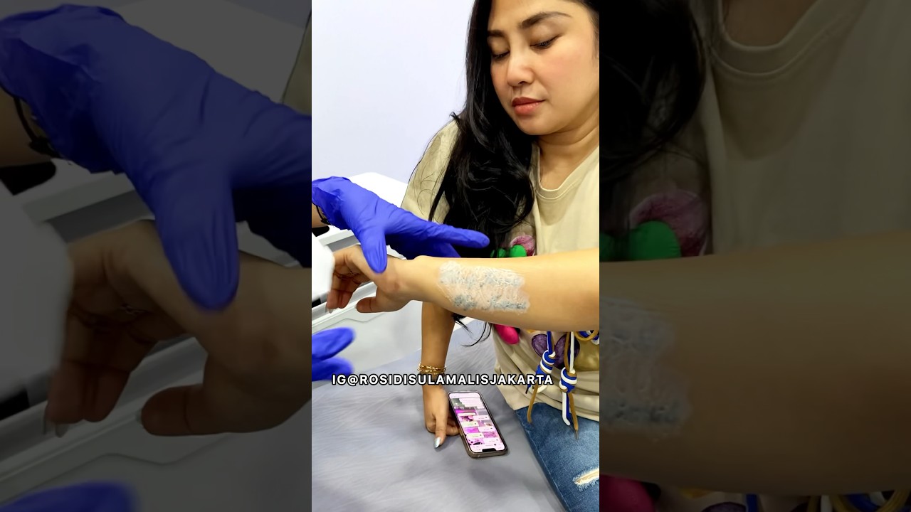 Laser Hapus Tatto Harga Murah