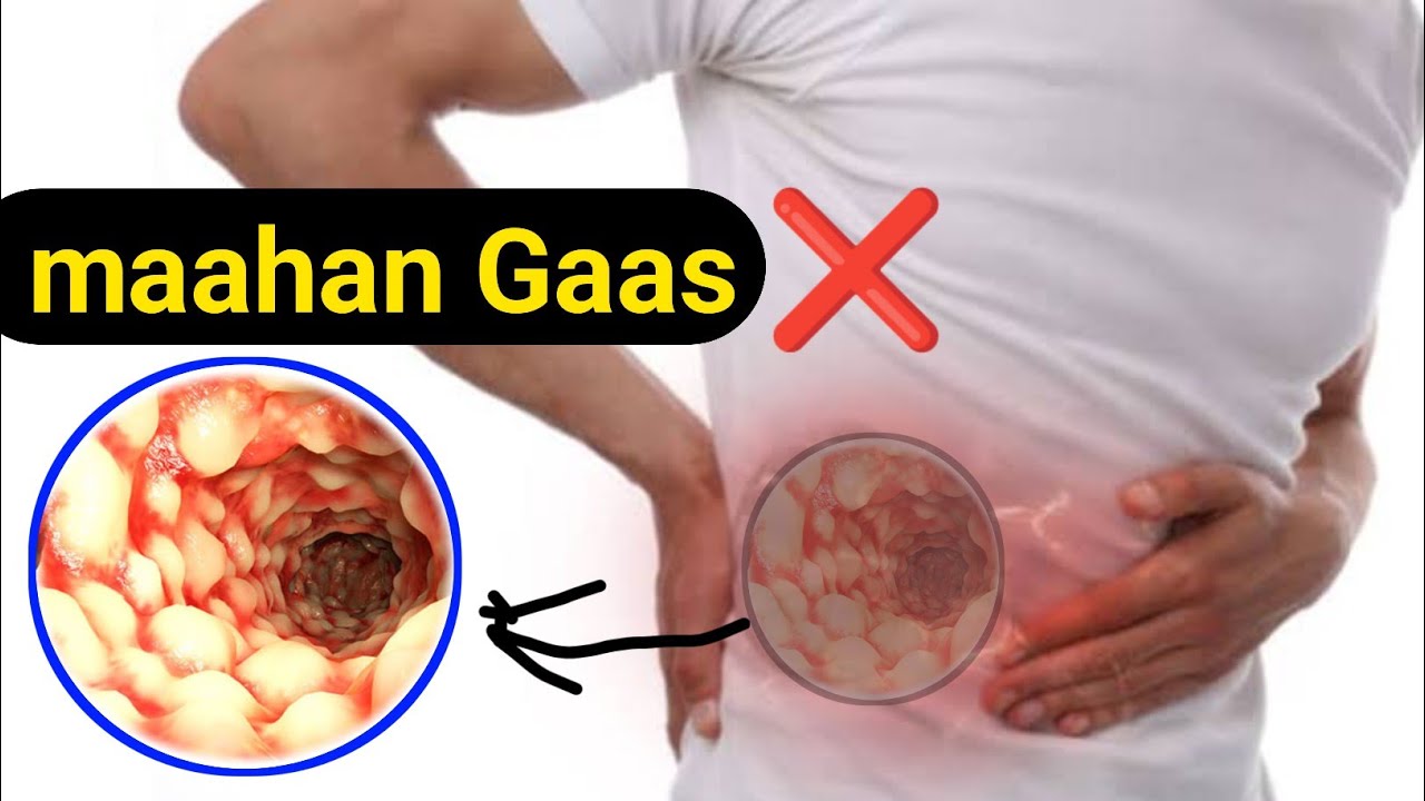 xanuunka crohn's disease ee lagu qaldo Gaaska iyo Tiifoowga